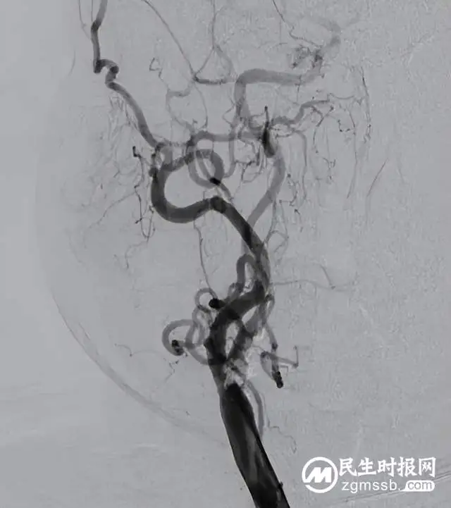 这种病致死率极高，看湘潭县人民医院卒中中心团队如何不开刀微创拆“炸弹”