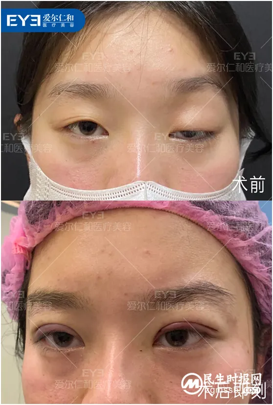 告别下垂的眼睛 人生更“睛”彩