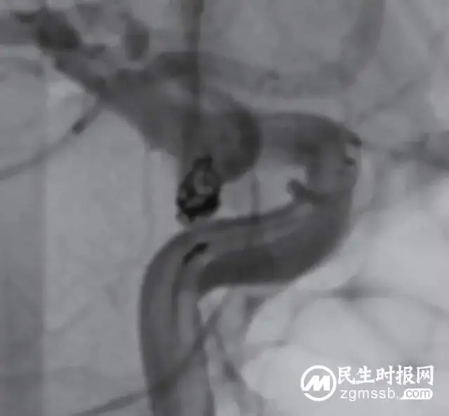 这种病致死率极高，看湘潭县人民医院卒中中心团队如何不开刀微创拆“炸弹”