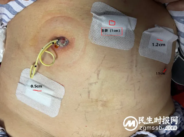 泌尿外科腔镜技术帮患者告别“蜈蚣”疤