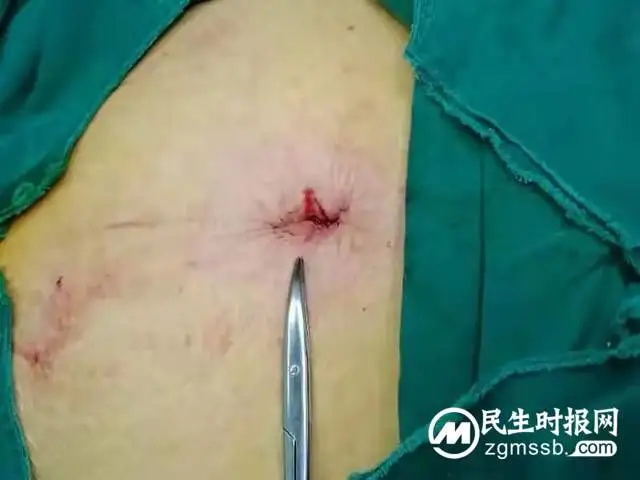 最微创的手术方式：经脐单孔免气腹腹腔镜手术