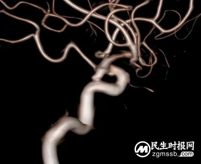 这种病致死率极高，看湘潭县人民医院卒中中心团队如何不开刀微创拆“炸弹”