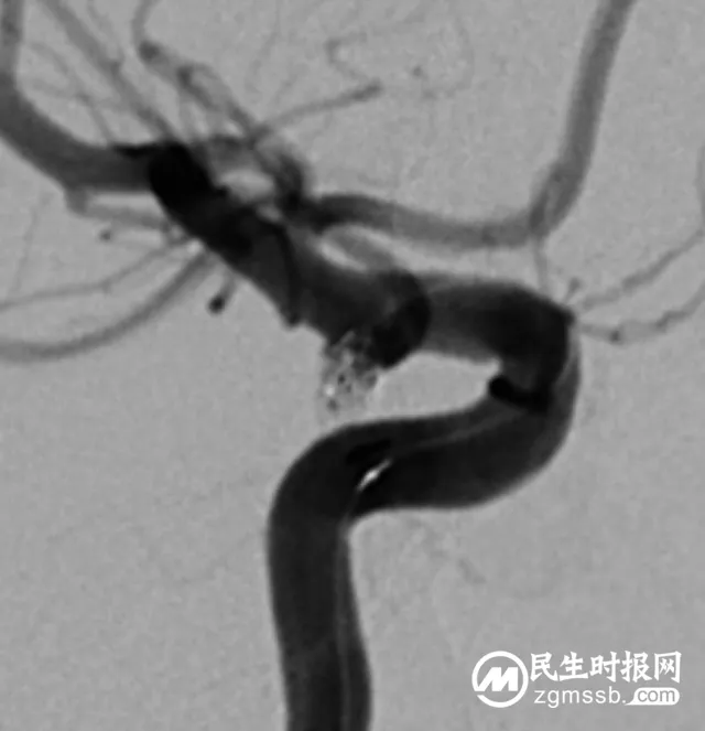 这种病致死率极高，看湘潭县人民医院卒中中心团队如何不开刀微创拆“炸弹”