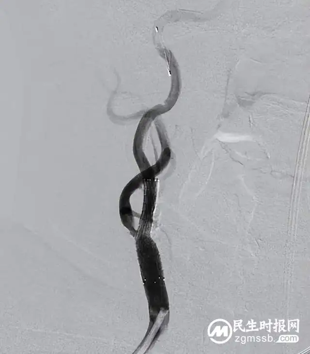 这种病致死率极高，看湘潭县人民医院卒中中心团队如何不开刀微创拆“炸弹”