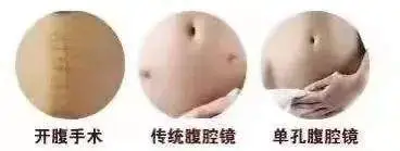 最微创的手术方式：经脐单孔免气腹腹腔镜手术