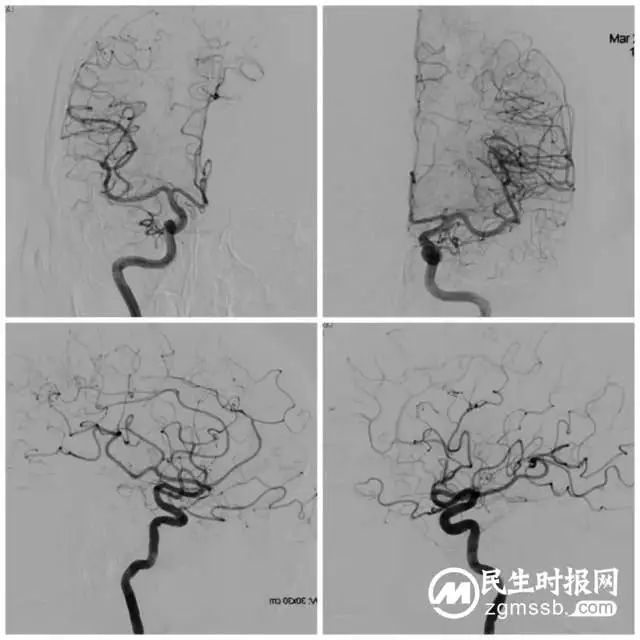 这种病致死率极高，看湘潭县人民医院卒中中心团队如何不开刀微创拆“炸弹”