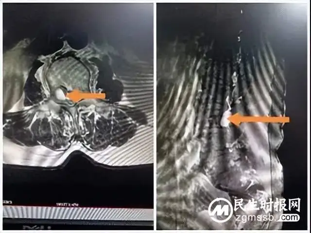 腰腿疼痛不一定是腰椎间盘突出，还有可能是这个原因