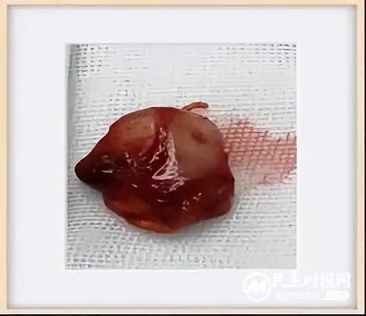 腰腿疼痛不一定是腰椎间盘突出，还有可能是这个原因