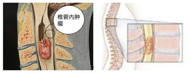腰腿疼痛不一定是腰椎间盘突出，还有可能是这个原因