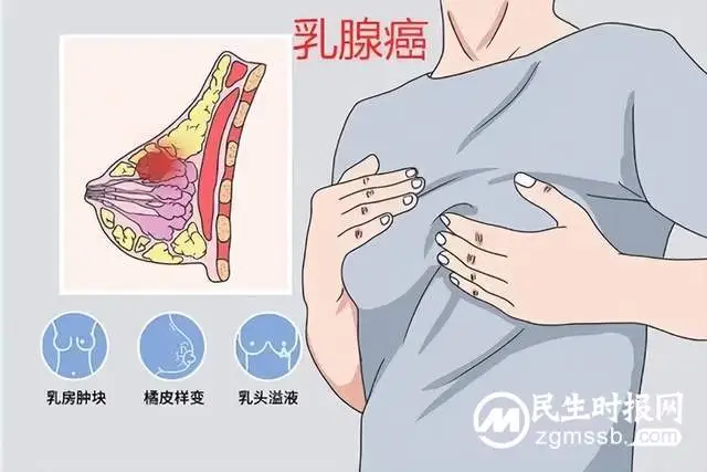 患乳腺癌后能保乳吗？能保住生命留住美吗？