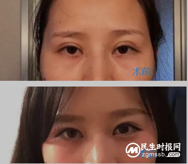 “青蛙眼”的蜕变之旅 “青蛙眼”的蜕变之旅