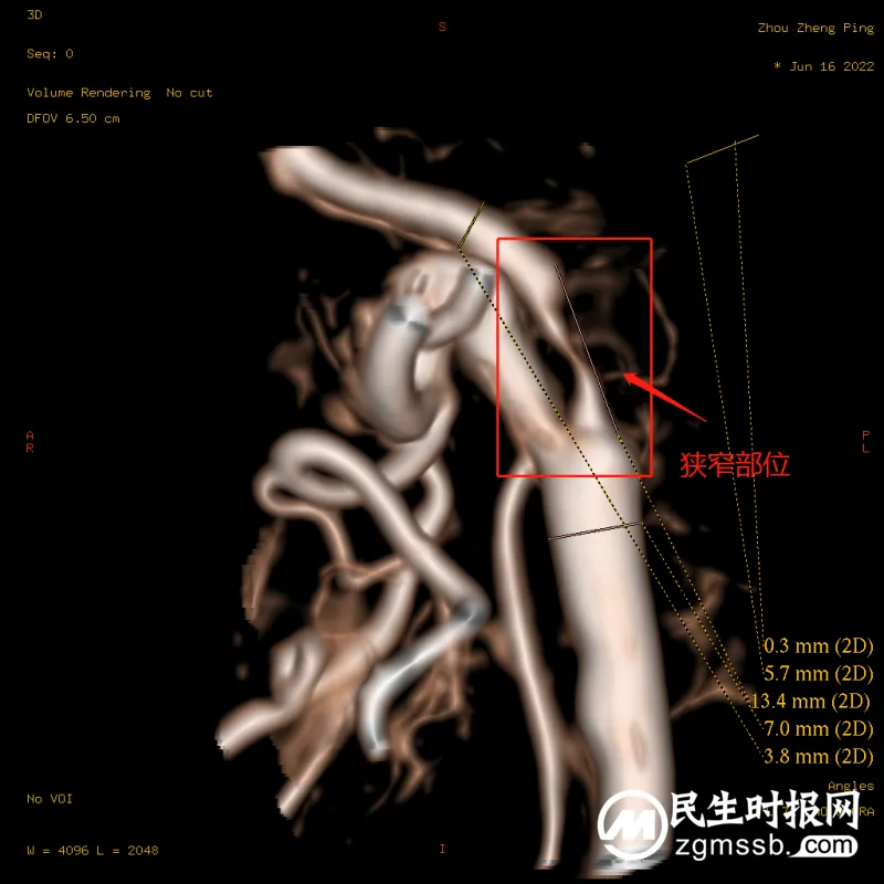 湘潭县人民医院卒中中心团队​为颈内动脉狭窄患者打通“生命通道”