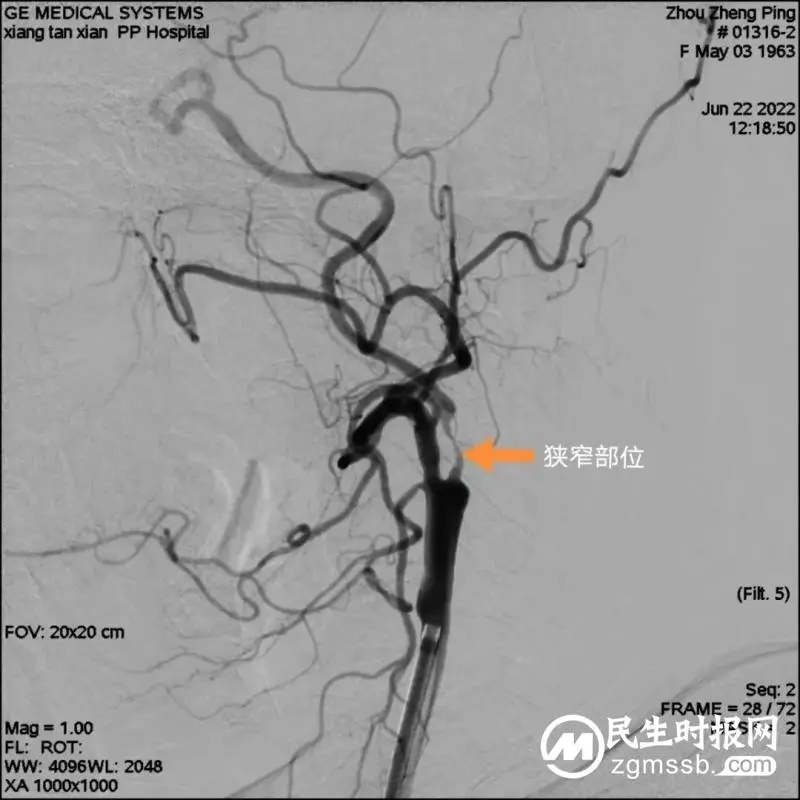 湘潭县人民医院卒中中心团队​为颈内动脉狭窄患者打通“生命通道”