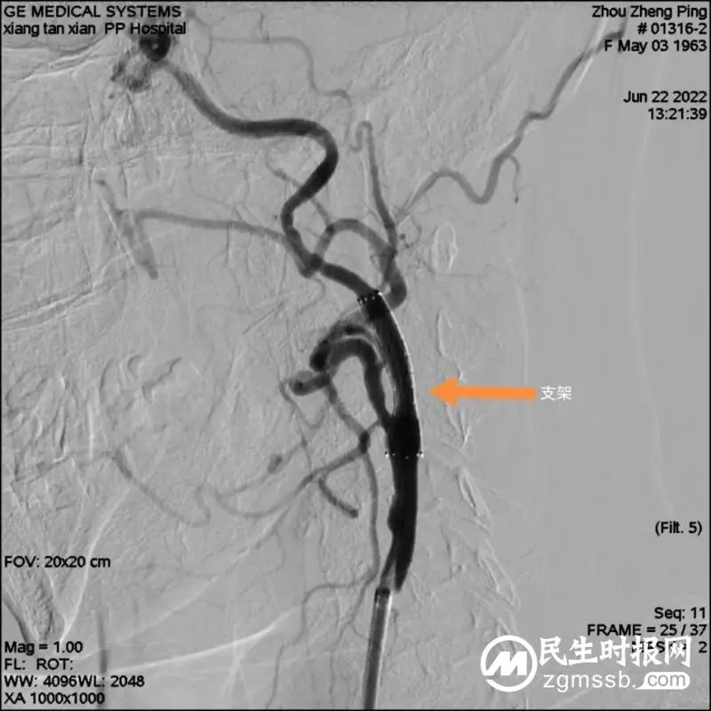 湘潭县人民医院卒中中心团队​为颈内动脉狭窄患者打通“生命通道”