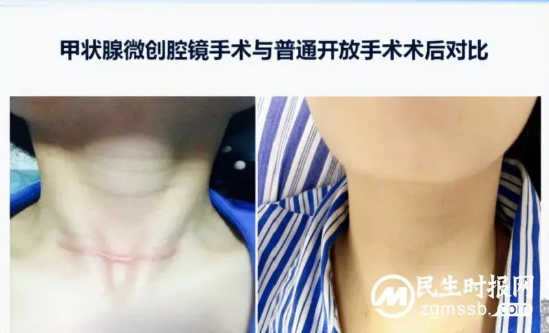 腔镜甲状腺微创手术 让颈部完美无痕