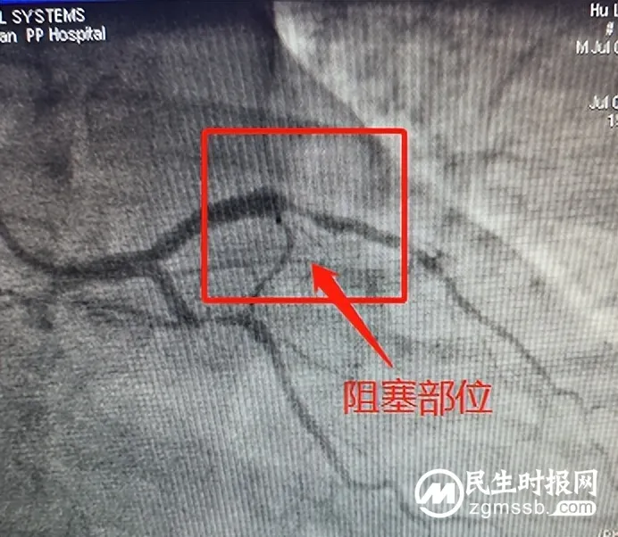 【医共体动态】速度与专业！胸痛中心区域协同救治，成功挽救年轻心梗患者生命