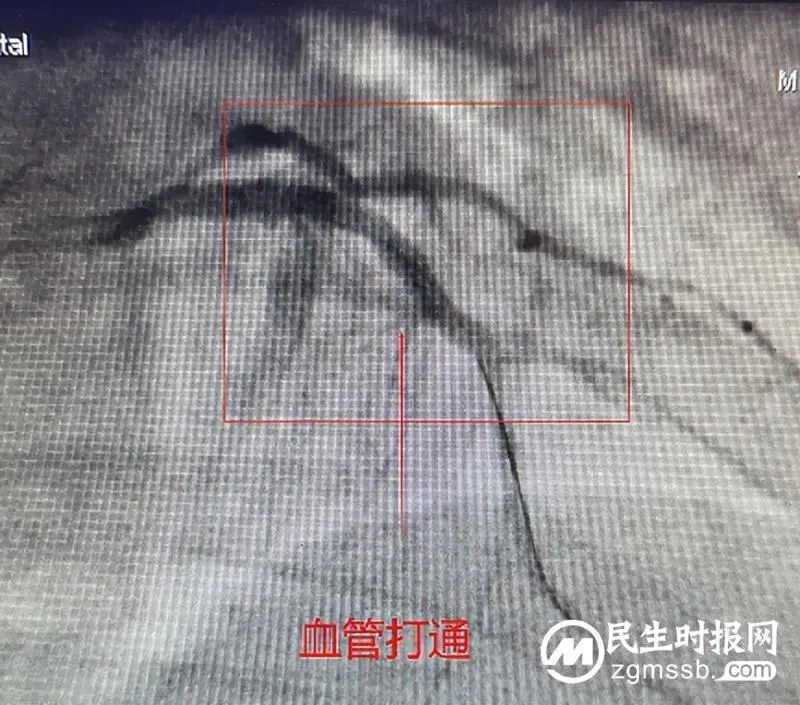 【医共体动态】速度与专业！胸痛中心区域协同救治，成功挽救年轻心梗患者生命