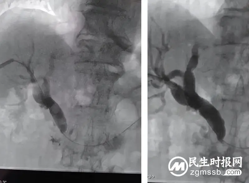 邯郸市第二医院多科联合实施经皮经肝胆道镜取石术