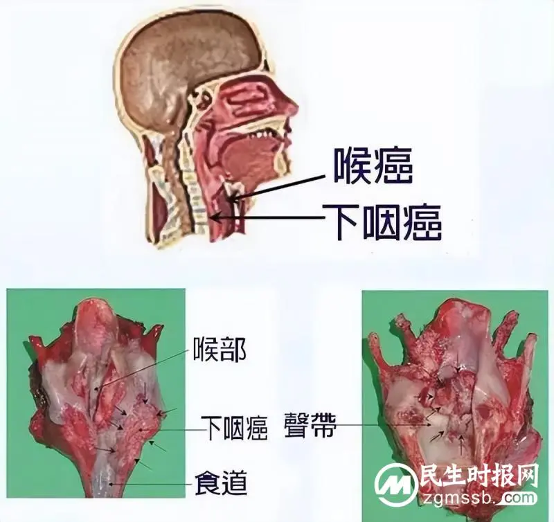 男子脖子长肿块,竟查出咽喉癌!医生:发现这些症状要尽快就医 男子脖子长肿块,竟查出咽喉癌!医生:发现这些症状要尽快就医