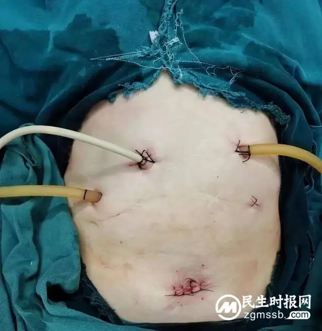 女子患胆管结石再做手术，相隔十年感受大不相同