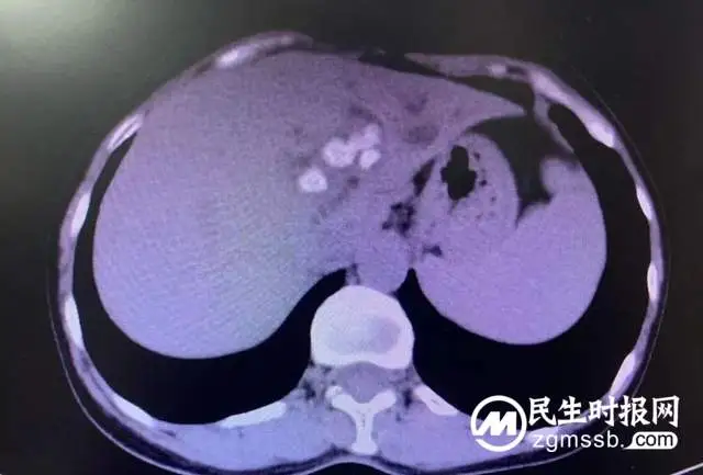 女子患胆管结石再做手术，相隔十年感受大不相同