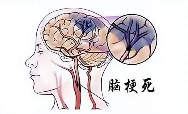 老人突发脑梗，湘潭县人民医院卒中团队与时间赛跑，为生命护航