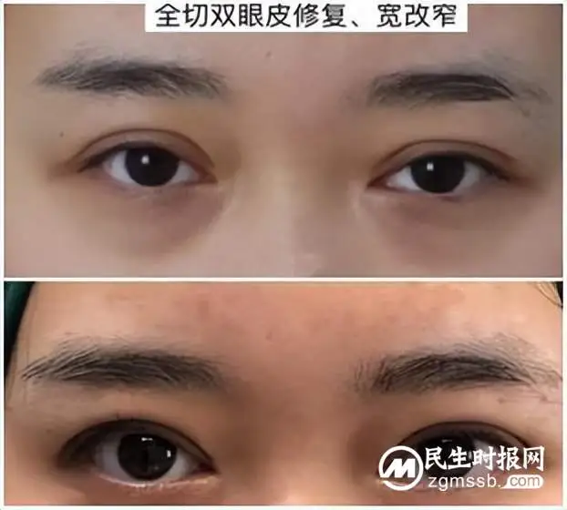 双眼皮修复好，心态也会好