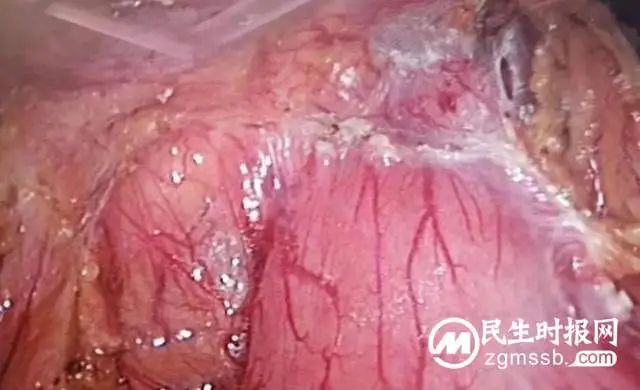 女子患胆管结石再做手术，相隔十年感受大不相同