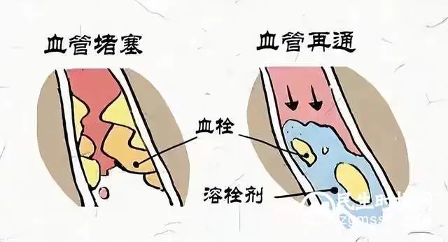老人突发脑梗，湘潭县人民医院卒中团队与时间赛跑，为生命护航