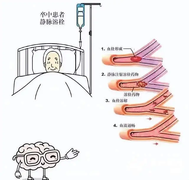 老人突发脑梗，湘潭县人民医院卒中团队与时间赛跑，为生命护航