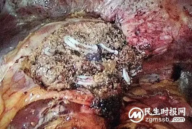 女子患胆管结石再做手术，相隔十年感受大不相同