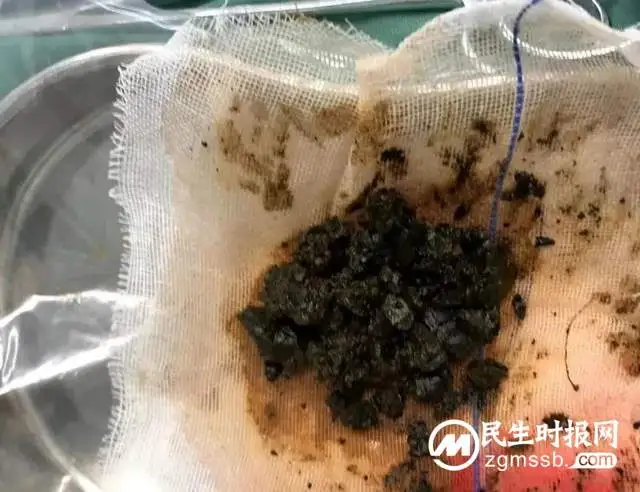 女子患胆管结石再做手术，相隔十年感受大不相同