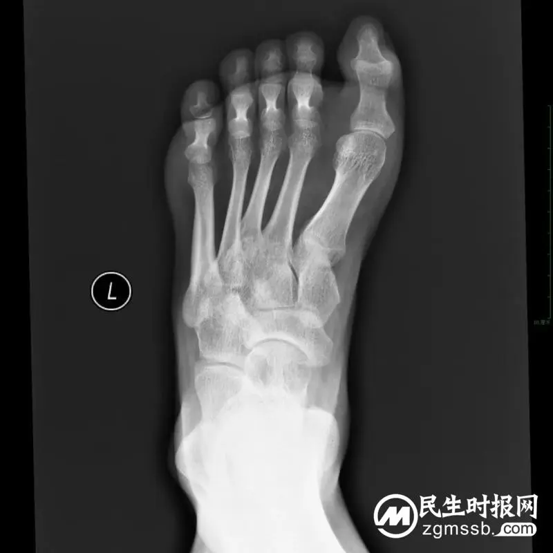 【中心医院·医者红】22岁河南驻马店小伙双足畸形10多年,在湖南湘潭治好了! 【中心医院·医者红】22岁河南驻马店小伙双足畸形10多年,在湖南湘潭治好了!