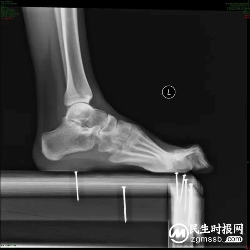 【中心医院·医者红】22岁河南驻马店小伙双足畸形10多年,在湖南湘潭治好了! 【中心医院·医者红】22岁河南驻马店小伙双足畸形10多年,在湖南湘潭治好了!