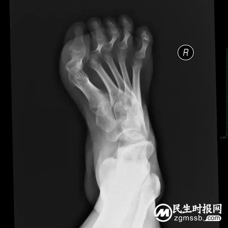 【中心医院·医者红】22岁河南驻马店小伙双足畸形10多年,在湖南湘潭治好了! 【中心医院·医者红】22岁河南驻马店小伙双足畸形10多年,在湖南湘潭治好了!