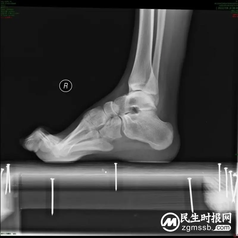 【中心医院·医者红】22岁河南驻马店小伙双足畸形10多年,在湖南湘潭治好了! 【中心医院·医者红】22岁河南驻马店小伙双足畸形10多年,在湖南湘潭治好了!