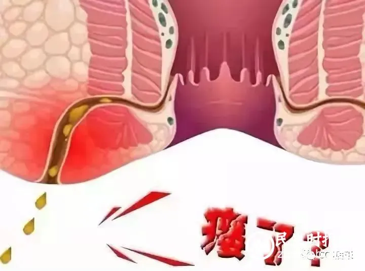 【健康科普】肛瘘可以自愈吗?不做手术可以吗? 【健康科普】肛瘘可以自愈吗?不做手术可以吗?