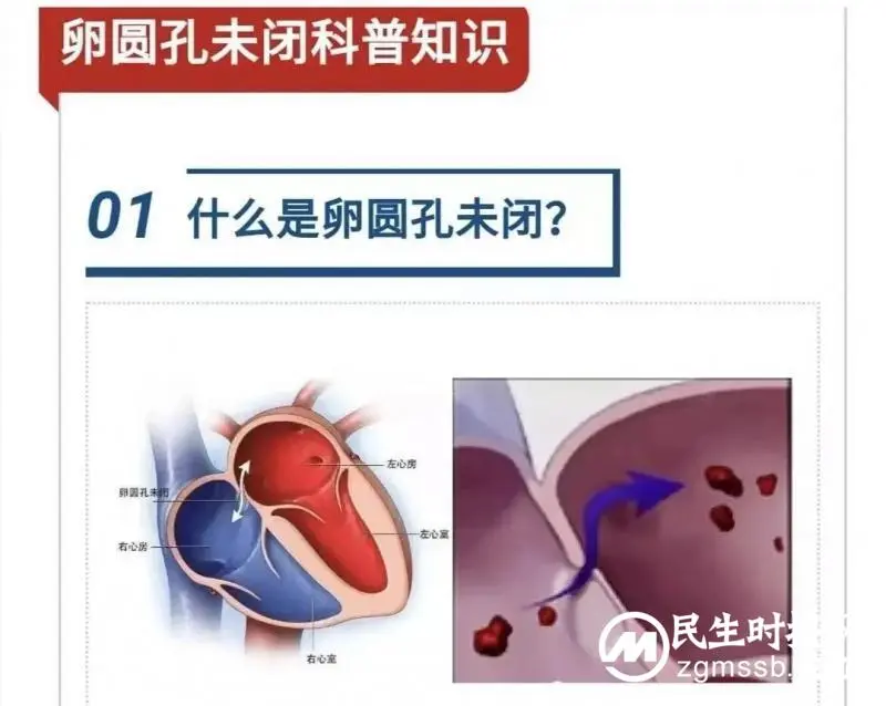 15岁就中风?医生:当心中风找上年轻的你 15岁就中风?医生:当心中风找上年轻的你