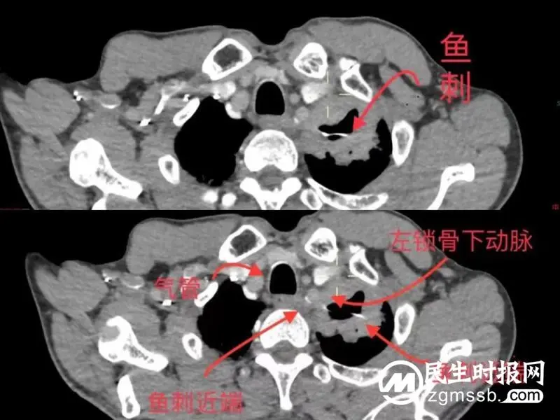 【中心医院·医者红】勇闯手术禁区，大胆“挑刺”