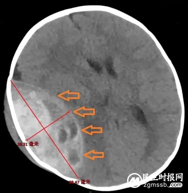 【中心医院·医者红】关爱儿童,谨防摔落!湘潭市中心医院一例重型颅脑伤患儿抢救纪实 【中心医院·医者红】关爱儿童,谨防摔落!湘潭市中心医院一例重型颅脑伤患儿抢救纪实