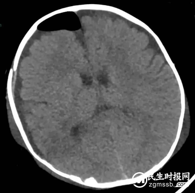 【中心医院·医者红】关爱儿童,谨防摔落!湘潭市中心医院一例重型颅脑伤患儿抢救纪实 【中心医院·医者红】关爱儿童,谨防摔落!湘潭市中心医院一例重型颅脑伤患儿抢救纪实