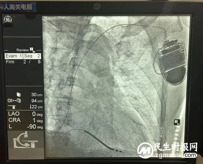 ICD植入成功救治一例心梗后恶性心律失常患者