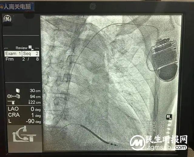 ICD植入成功救治一例心梗后恶性心律失常患者