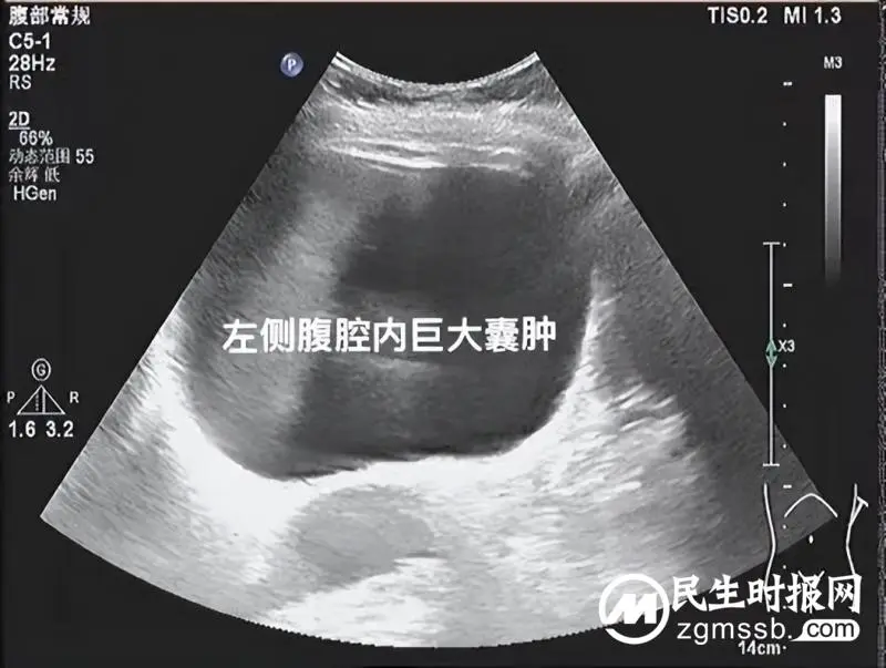 【中心医院·医者红】小针头解决大问题——超声引导下囊肿穿刺硬化术 【中心医院·医者红】小针头解决大问题——超声引导下囊肿穿刺硬化术