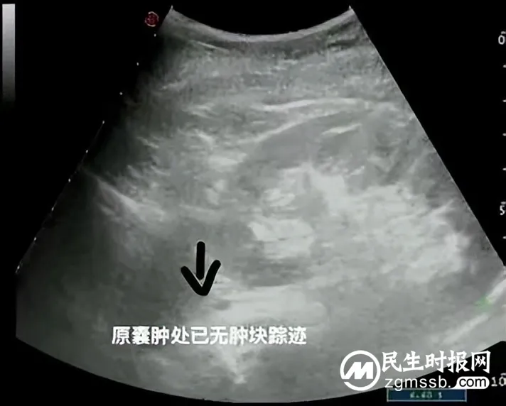 【中心医院·医者红】小针头解决大问题——超声引导下囊肿穿刺硬化术 【中心医院·医者红】小针头解决大问题——超声引导下囊肿穿刺硬化术