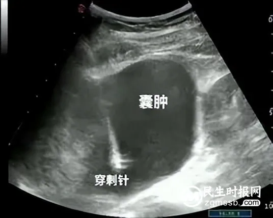 【中心医院·医者红】小针头解决大问题——超声引导下囊肿穿刺硬化术 【中心医院·医者红】小针头解决大问题——超声引导下囊肿穿刺硬化术