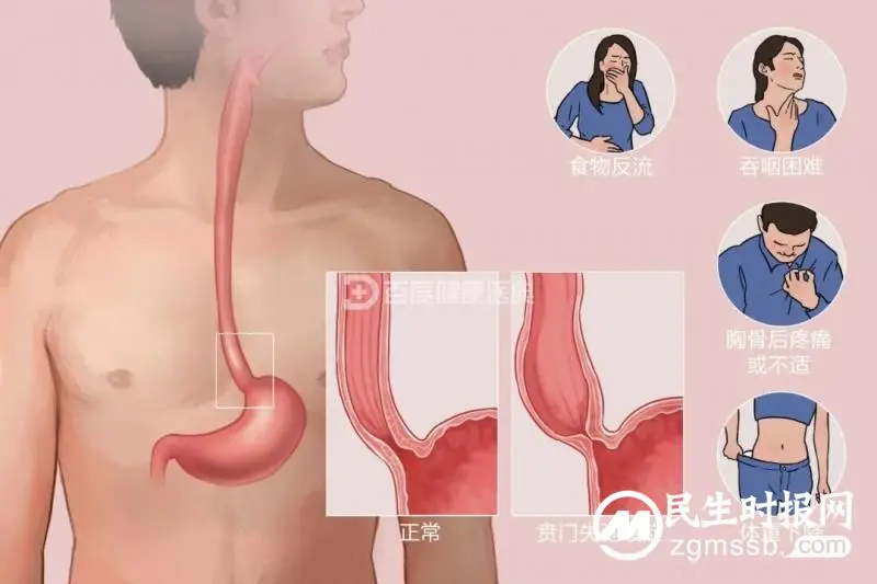吞咽困难再反复，介入治疗一招除！