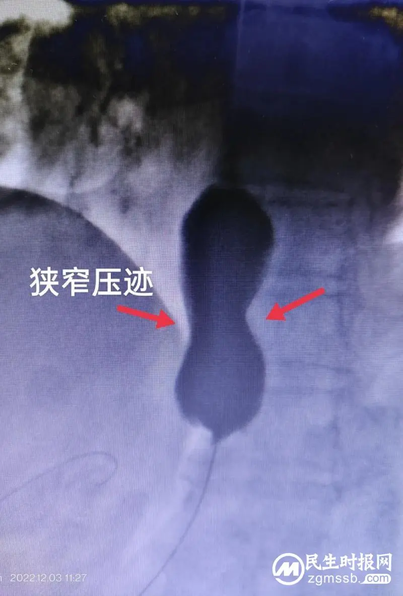 吞咽困难再反复，介入治疗一招除！
