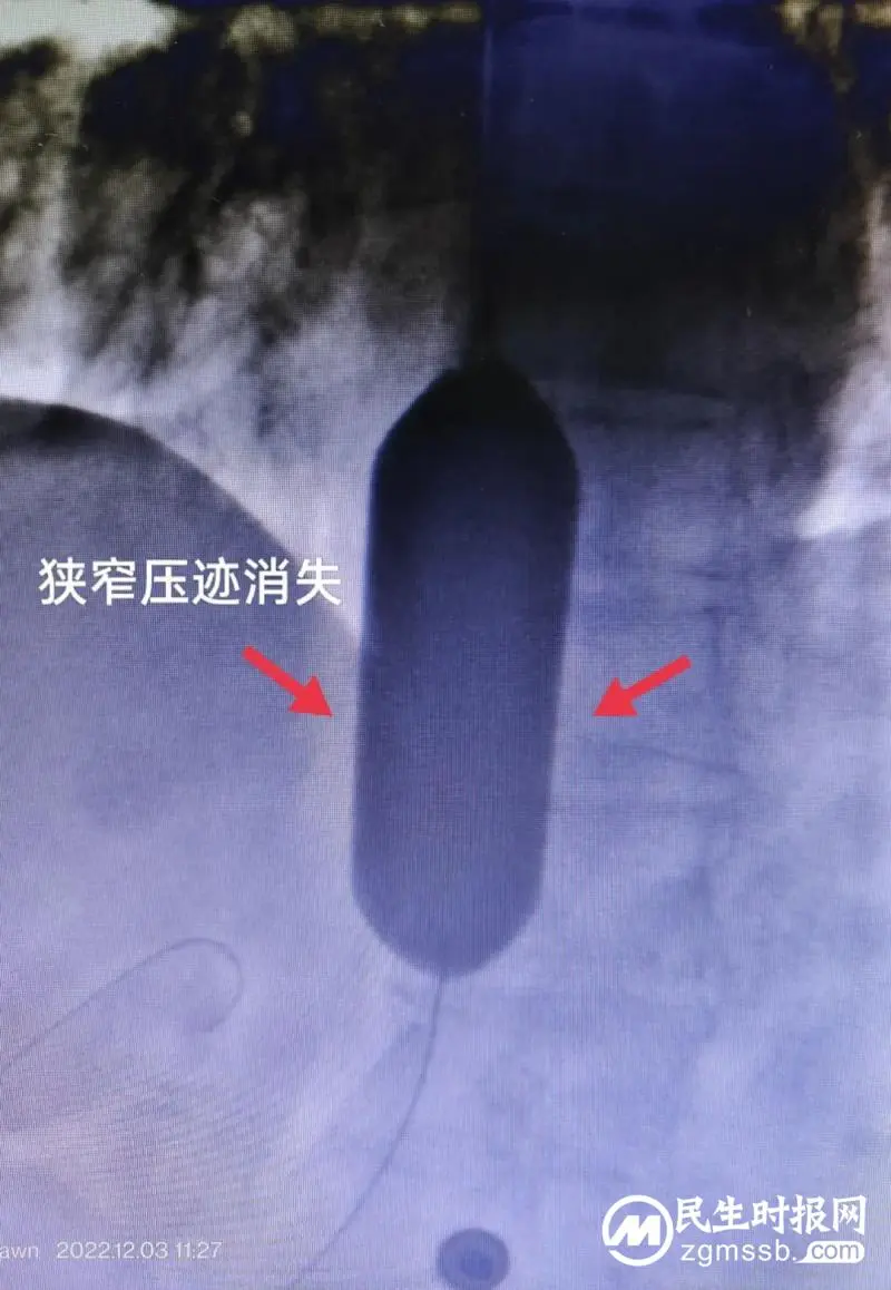 吞咽困难再反复，介入治疗一招除！