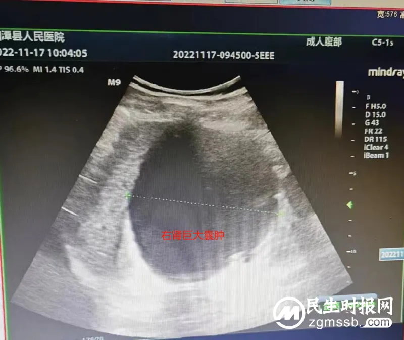 超微创!医院开展超声引导下肾囊肿穿刺硬化治疗术 超微创!医院开展超声引导下肾囊肿穿刺硬化治疗术